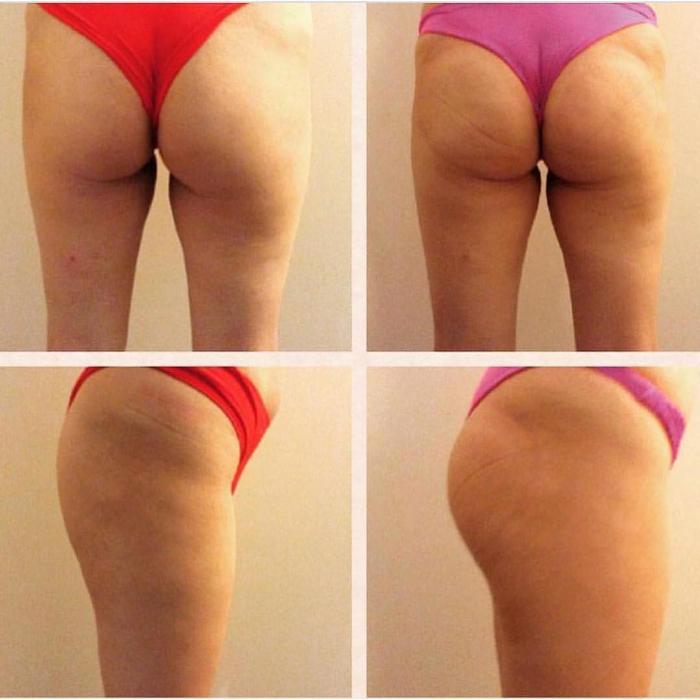 Body Lyft System - Carmel, IN