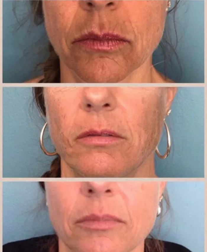 Body Lyft System - Carmel, IN