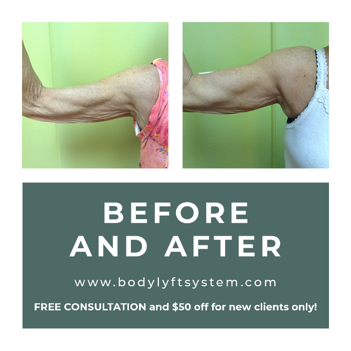 Body Lyft System - Carmel, IN