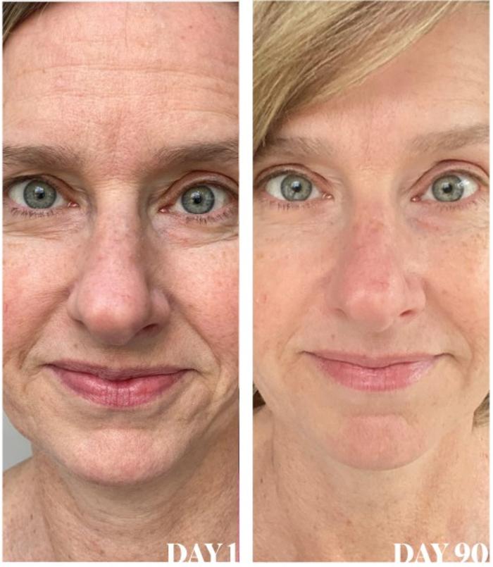 Body Lyft System - Carmel, IN