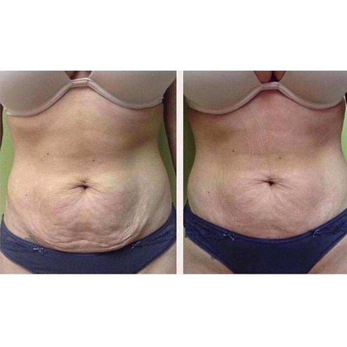 Body Lyft System - Carmel, IN