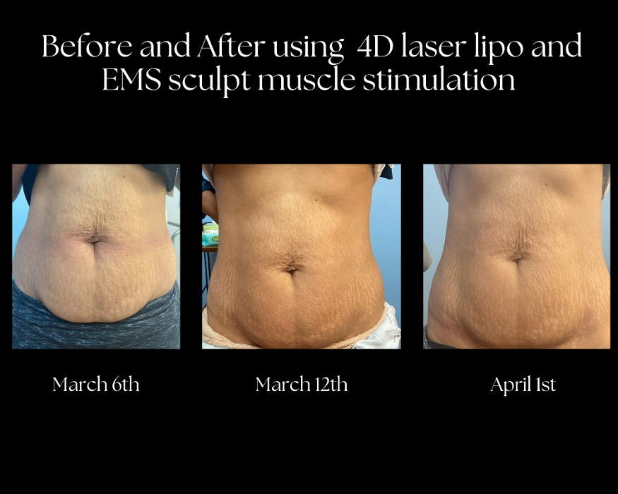 Body Lyft System - Carmel, IN