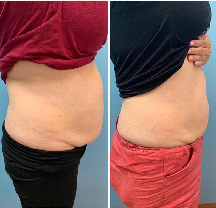 Body Lyft System - Carmel, IN