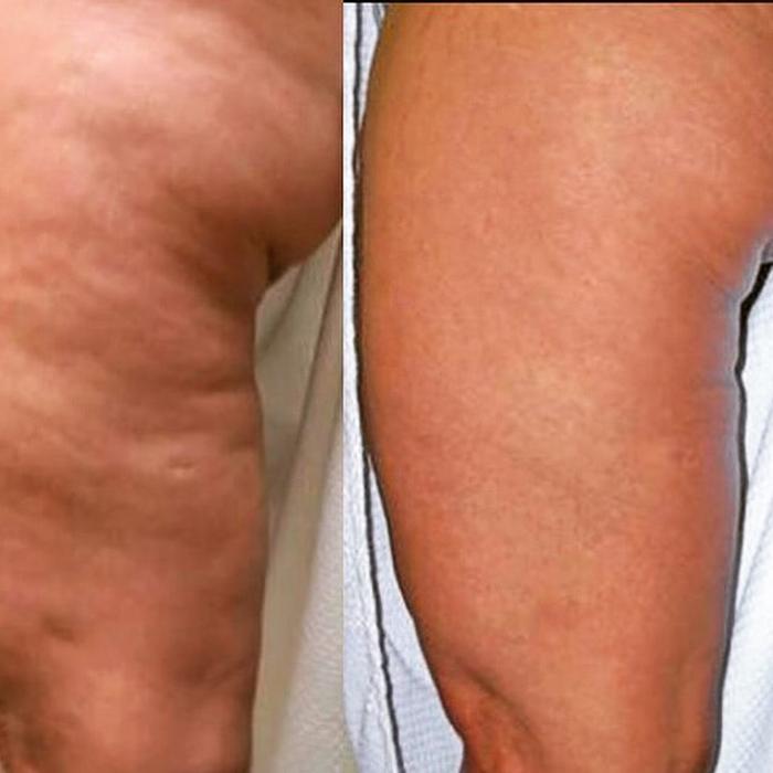 Body Lyft System - Carmel, IN