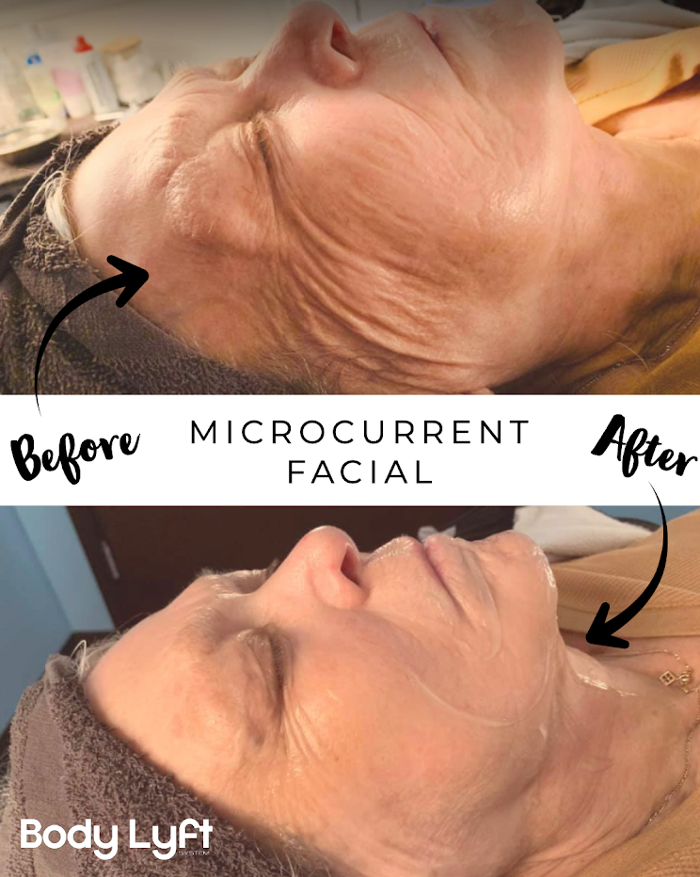 Body Lyft System - Carmel, IN