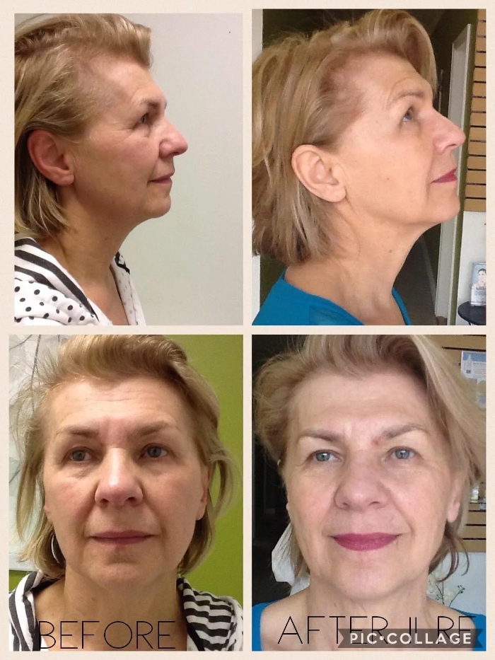 Body Lyft System - Carmel, IN