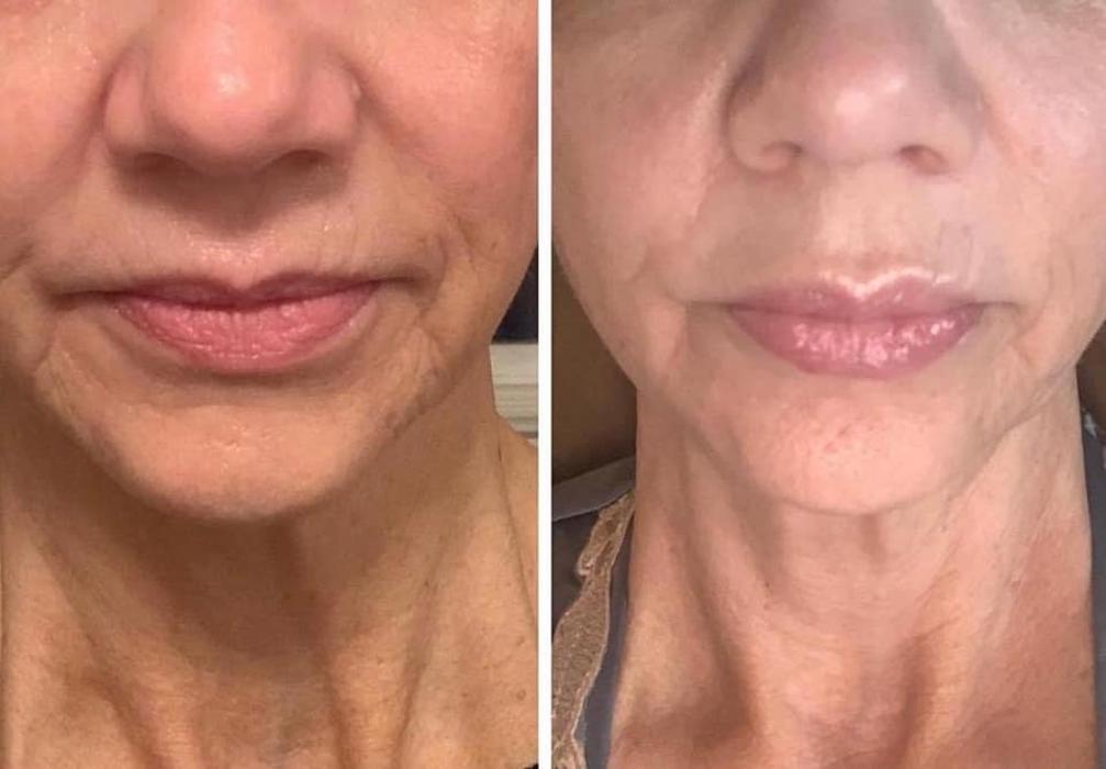 Body Lyft System - Carmel, IN