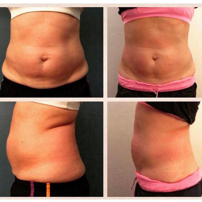 Body Lyft System - Carmel, IN