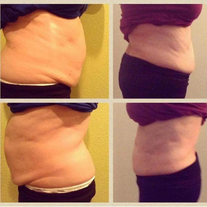 Body Lyft System - Carmel, IN