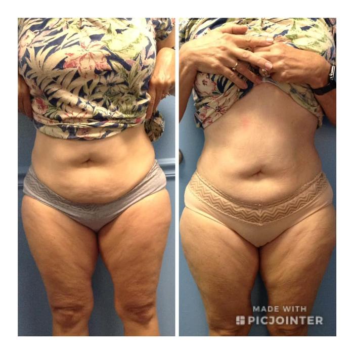 Body Lyft System - Carmel, IN