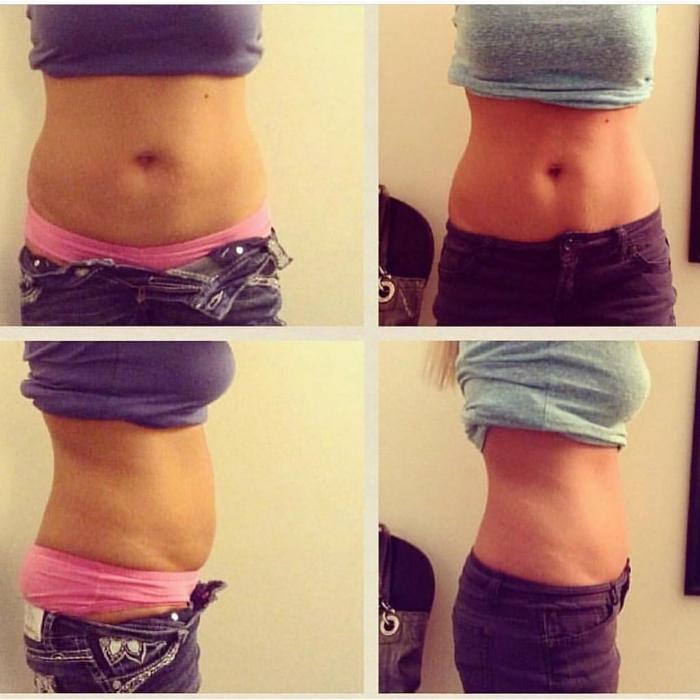 Body Lyft System - Carmel, IN