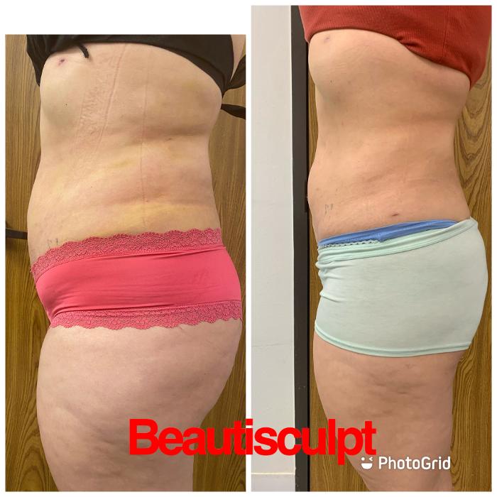 Beautisculpt Studio LLC - Stafford, TX