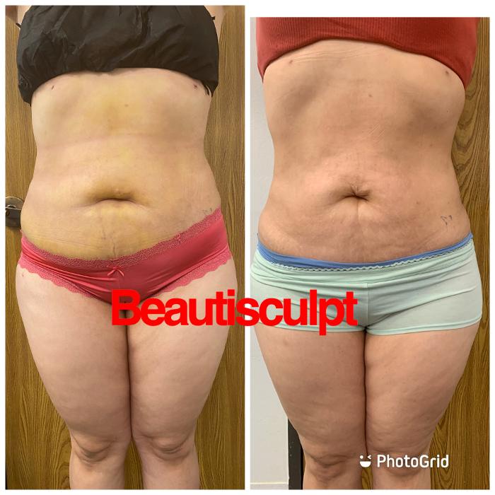 Beautisculpt Studio LLC - Stafford, TX