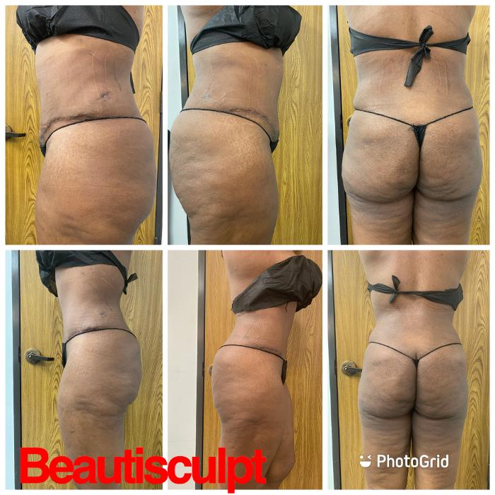 Beautisculpt Studio LLC - Stafford, TX