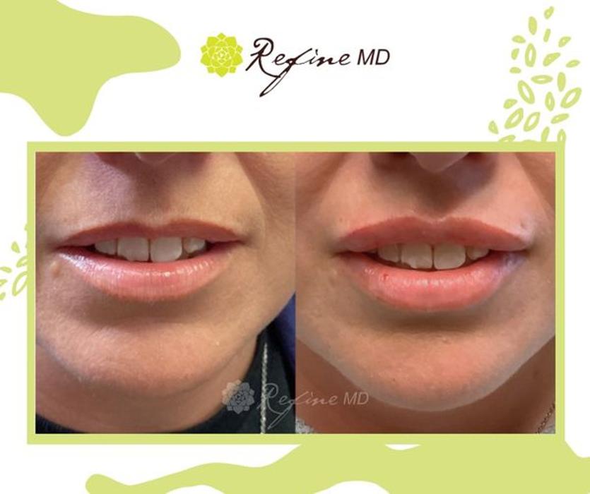 Refine MD - Menasha, WI