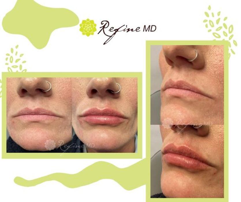 Refine MD - Menasha, WI