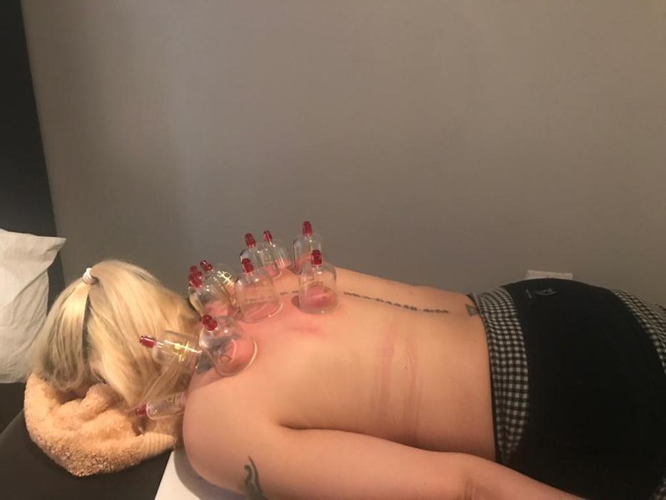 Treatment: Cupping
