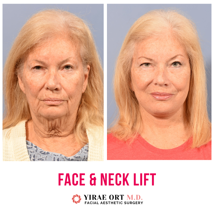 Yirae Ort MD Facial Aesthetic Surgery