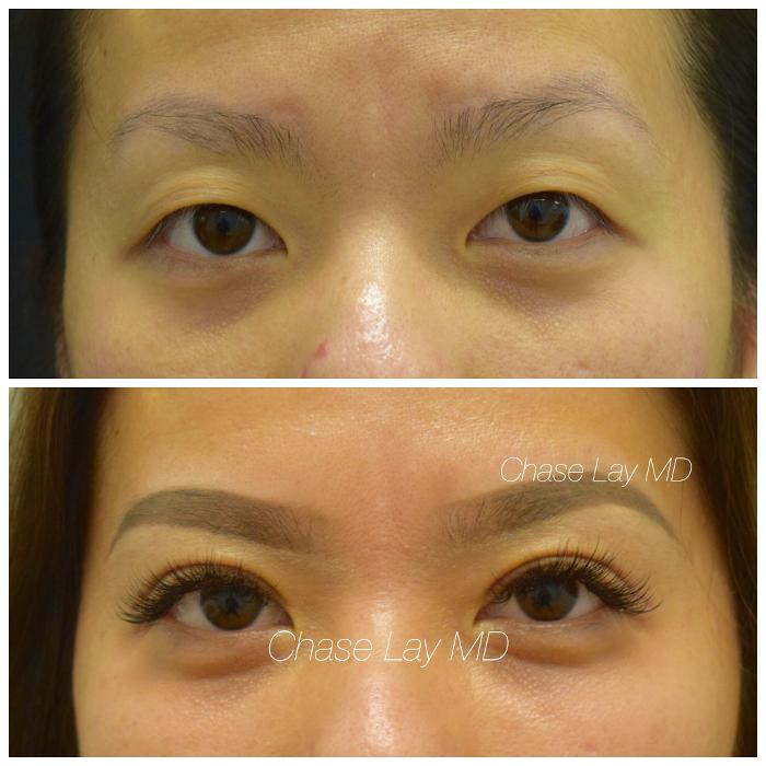 Chase Lay, MD | Facial Plastics & Asian Eyelid Surgery