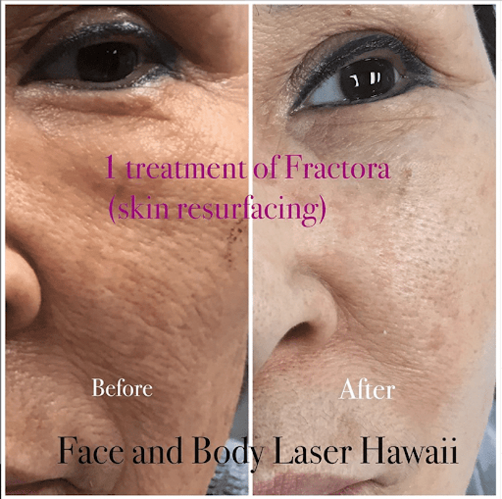 Face and Body Laser - Honolulu, HI