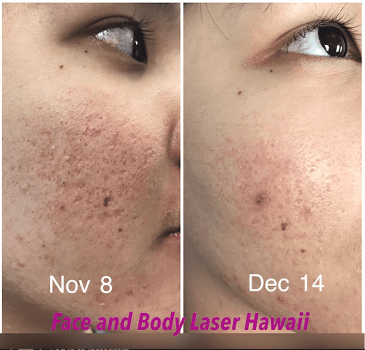 Face and Body Laser - Honolulu, HI
