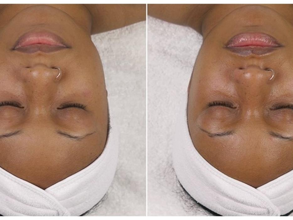 Schweiger Dermatology Group - Mt Vernon - Mount Vernon, IL