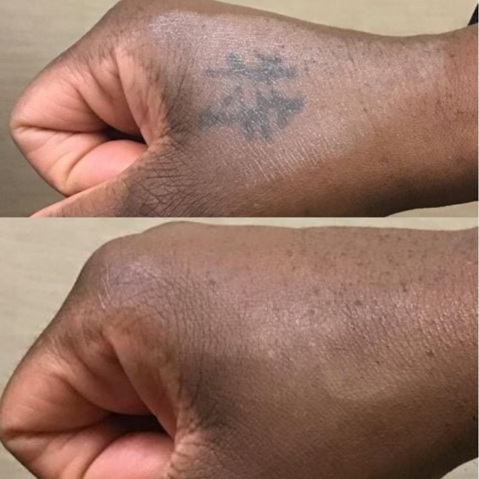 Removery Tattoo Removal & Fading