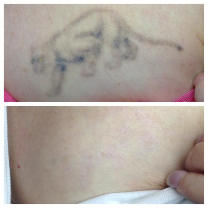 Removery Tattoo Removal & Fading - Framingham, MA