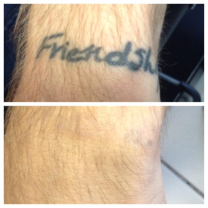 Removery Tattoo Removal & Fading - Framingham, MA