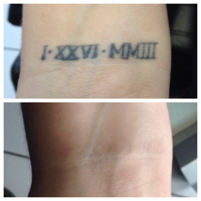 Removery Tattoo Removal & Fading - Framingham, MA
