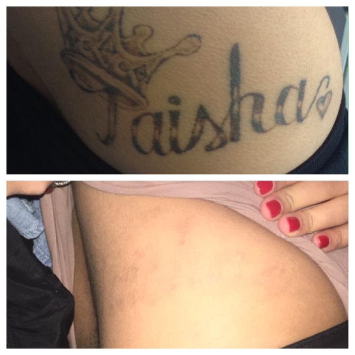 Removery Tattoo Removal & Fading - Framingham, MA