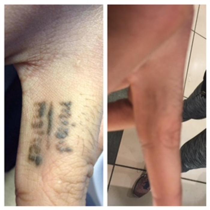 Removery Tattoo Removal & Fading - Framingham, MA