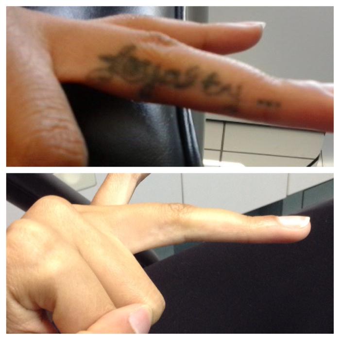 Removery Tattoo Removal & Fading - Framingham, MA