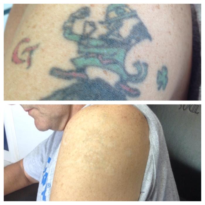 Removery Tattoo Removal & Fading - Framingham, MA