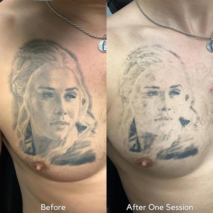 Removery Tattoo Removal & Fading