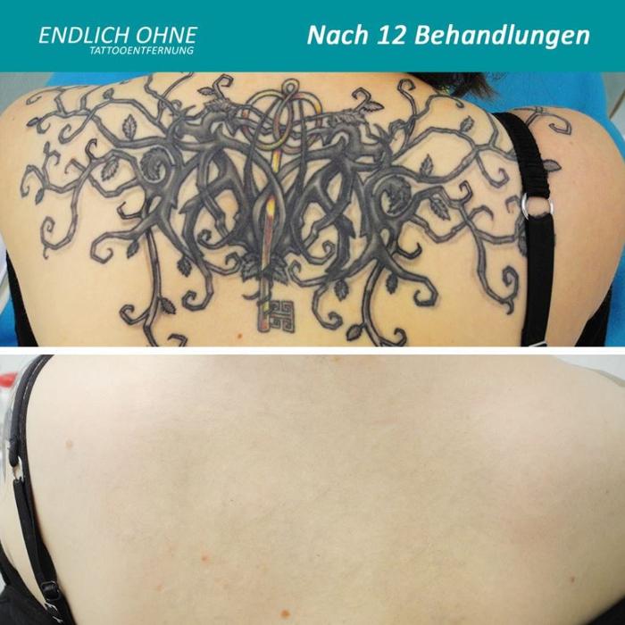 ENDLICH OHNE Tattooentfernung Filiale Saarbrücken, Schützenstraße in Saarbrücken