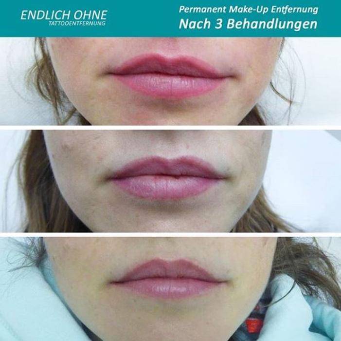 ENDLICH OHNE Tattooentfernung Filiale Leipzig, Magazingasse in Leipzig