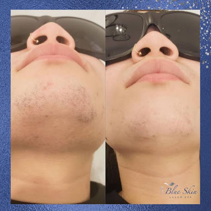 Blue Skin Laser Spa - Bronx, NY