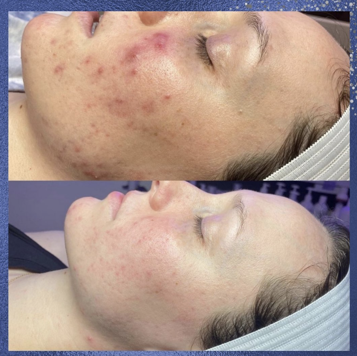 Blue Skin Laser Spa - Bronx, NY