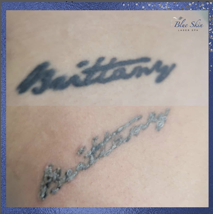 Blue Skin Laser Spa - Bronx, NY