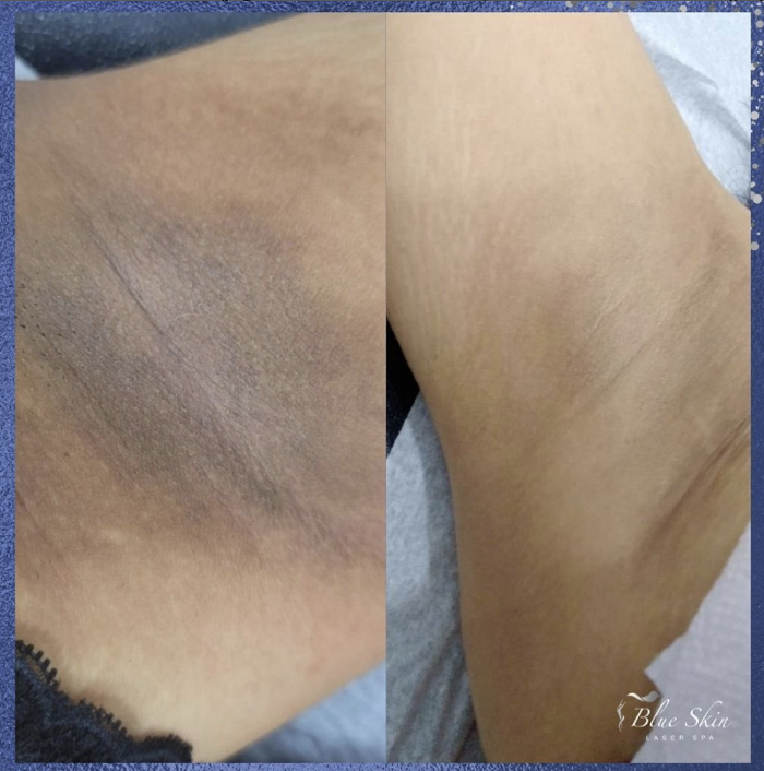 Blue Skin Laser Spa - Bronx, NY