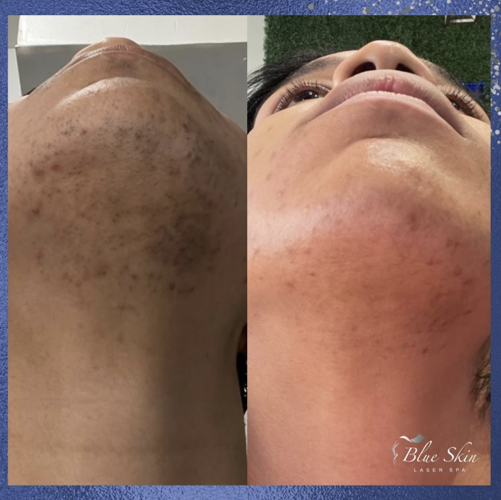 Blue Skin Laser Spa - Bronx, NY