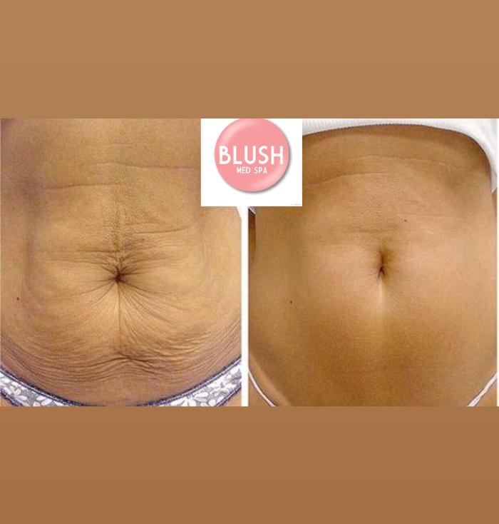 Blush Med Spa - Enfield, CT