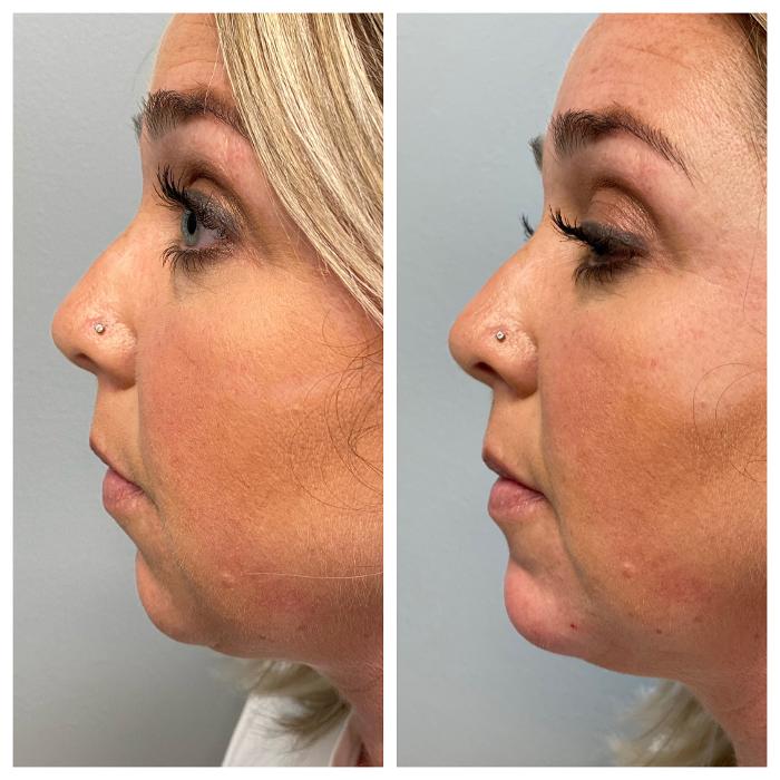 Blush Med Spa - Enfield, CT