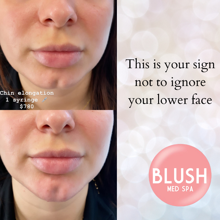 Blush Med Spa - Avon, CT