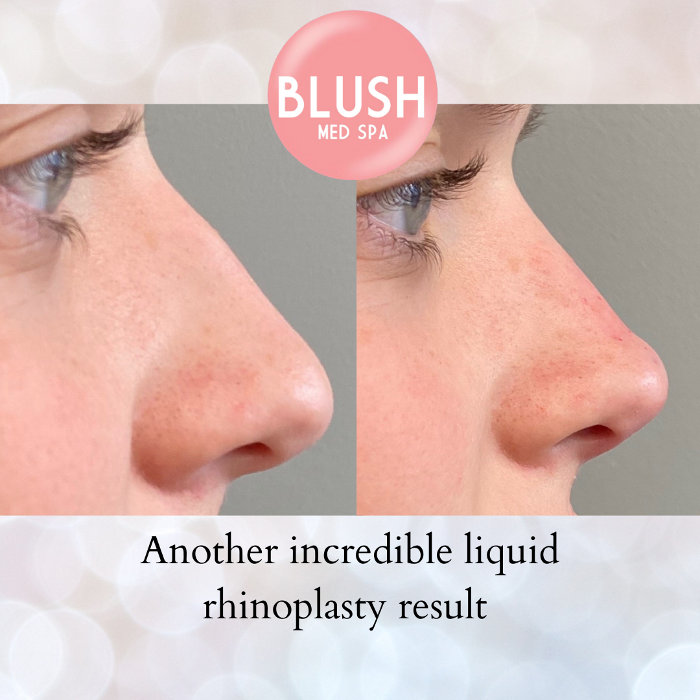 Blush Med Spa - Avon, CT