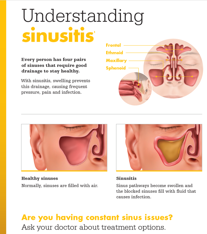 Understanding sinusitis