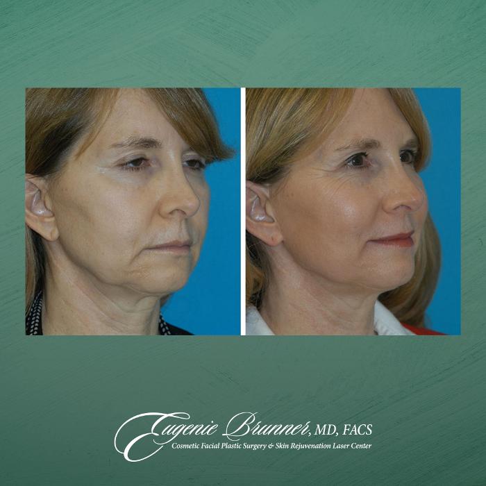 Eugenie Brunner, MD, FACS - Princeton, NJ