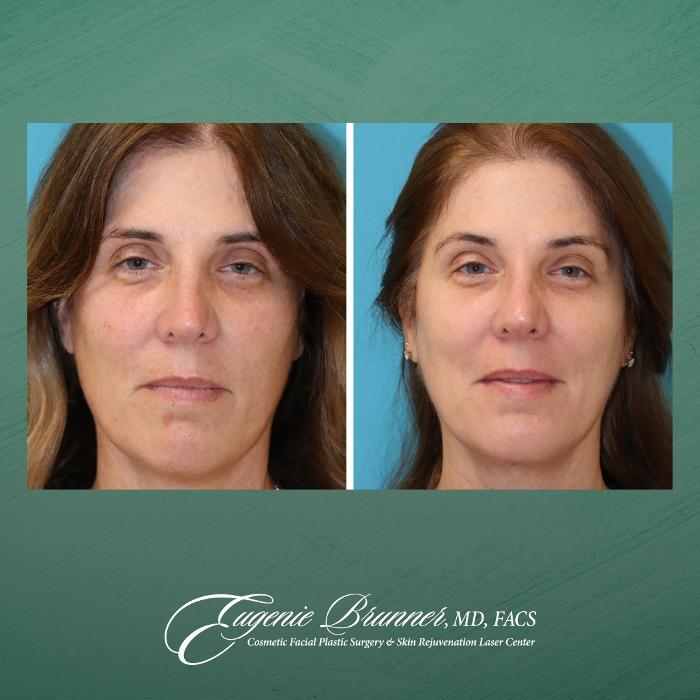 Eugenie Brunner, MD, FACS - Princeton, NJ