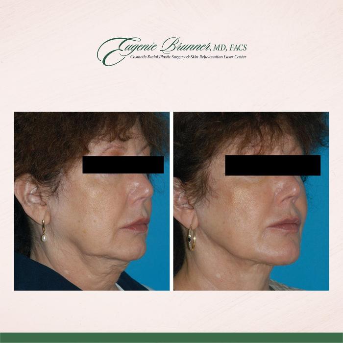 Eugenie Brunner, MD, FACS - Princeton, NJ